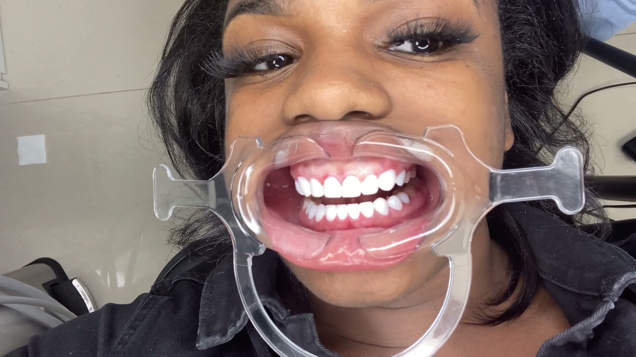 Composite Veneers Procedure At DentalDesign Smile Miami With @thearielpryor
