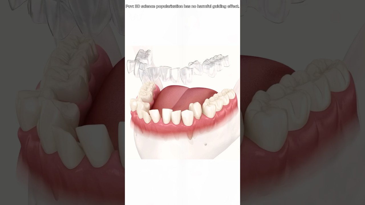 How Invisalign Aligners Work? (3D Animation) 