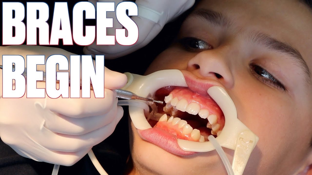 GETTING BRACES FOR THE FIRST TIME | HOW TO SHORTEN TIME WITH BRACES BY SIX MONTHS!