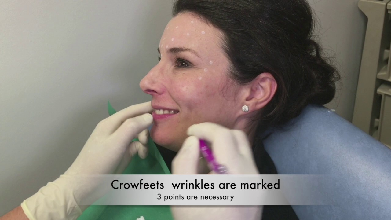 Forehead and crow's feet botox