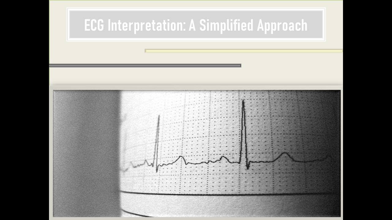 ECG Simplified: A Clear and Comprehensive Approach to Interpretation