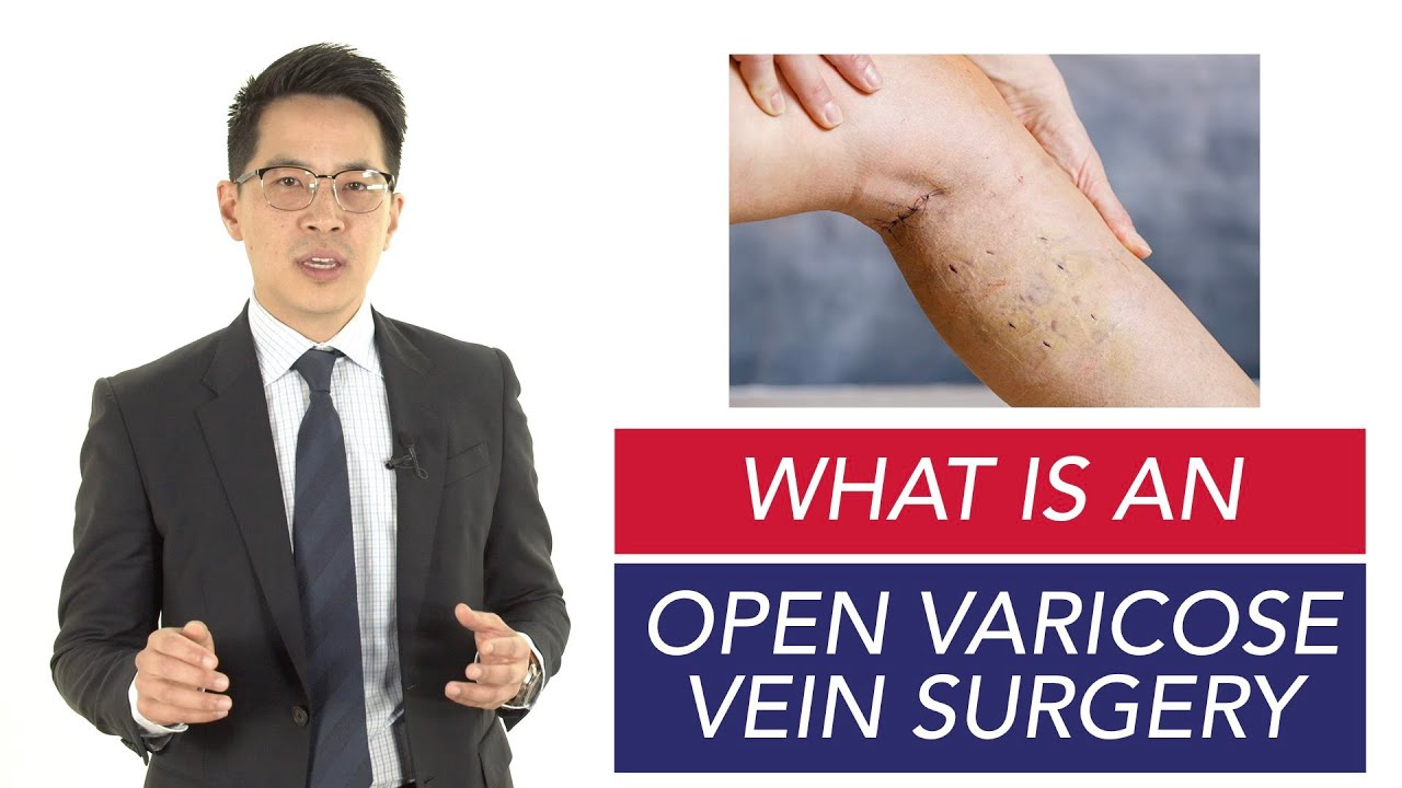 Is OPEN VARICOSE VEIN SURGERY The Most SUCCESSFUL Treatment?