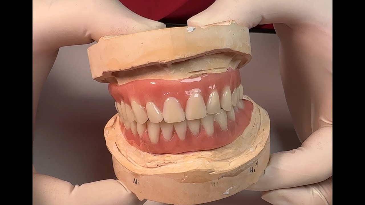 Frictie-Steg prothese, muurvast, klikgebit, gehemelte vrije prothese, kunstgebit zonder gehemelte!