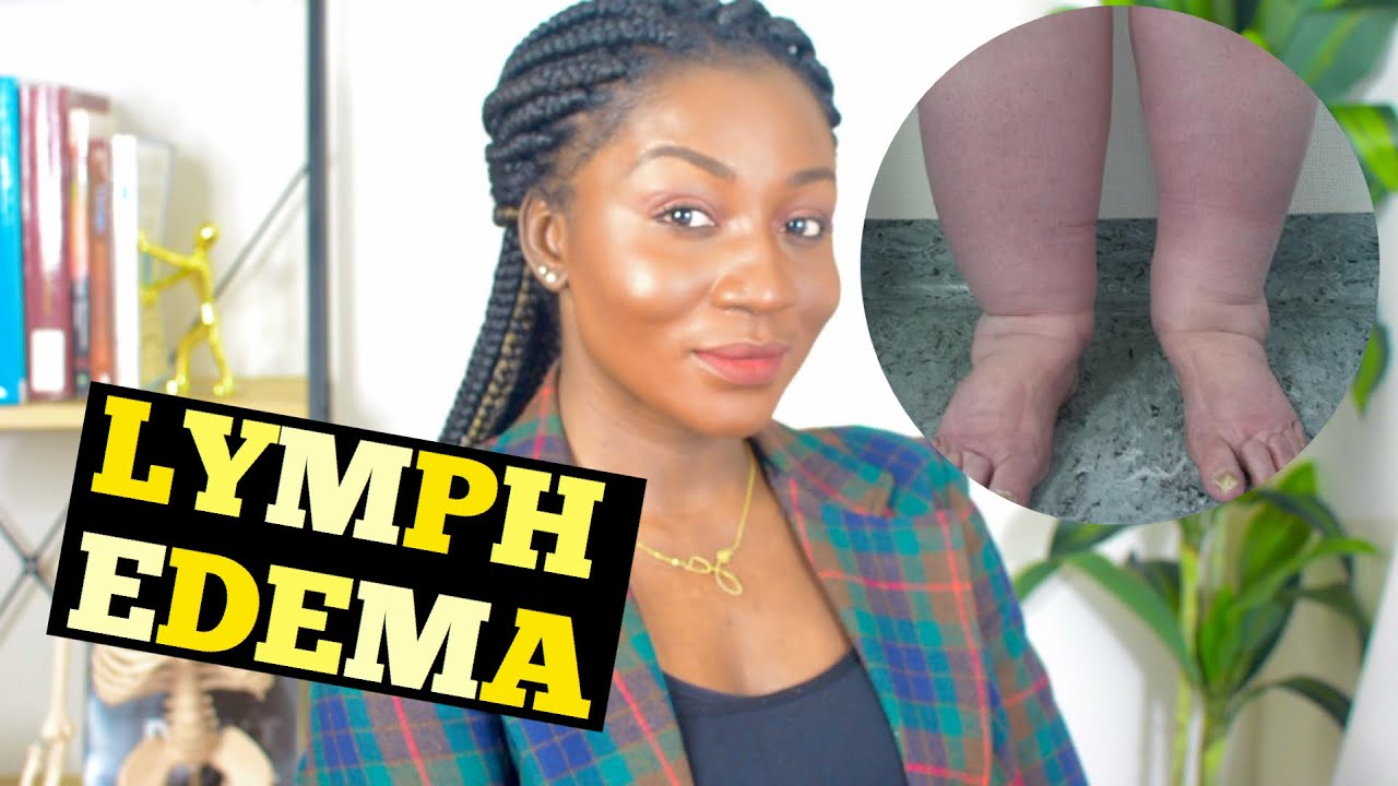 LYMPHEDEMA THERAPY and treatments at HOME - OCCUPATIONAL THERAPY ROLE