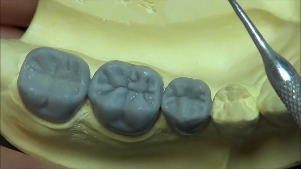 Live wax up - Lower Posterior bridge (occlusion2)