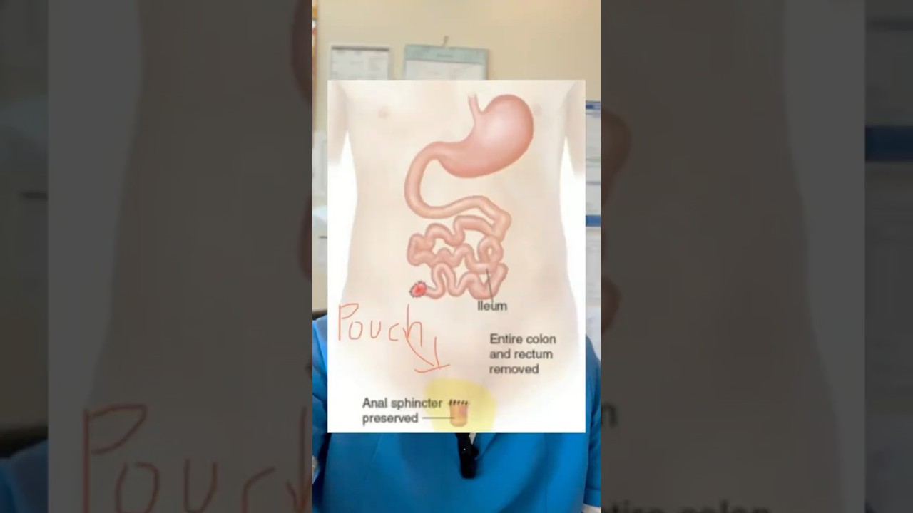 Hartmann&rsquo;s procedure & Hartmann&rsquo;s pouch (proctosigmoidectomy)