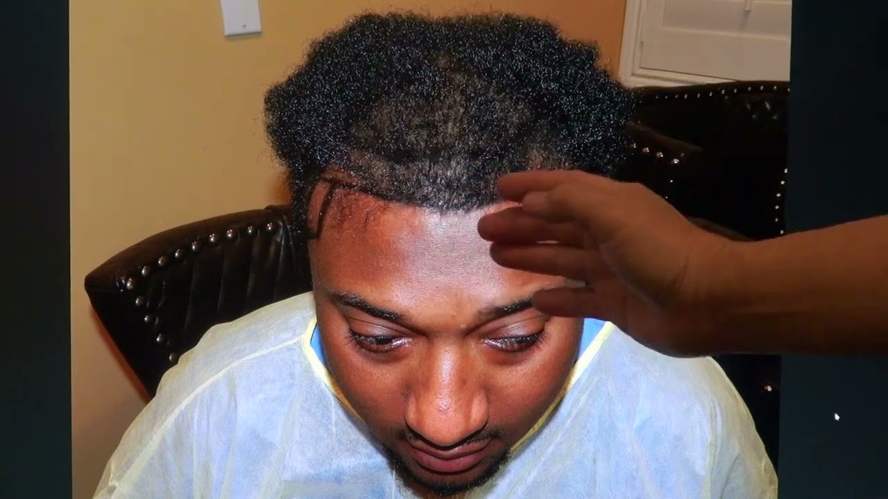 Hair Loss Treatment for Men | [Type of transplant] (# Hair grafts)