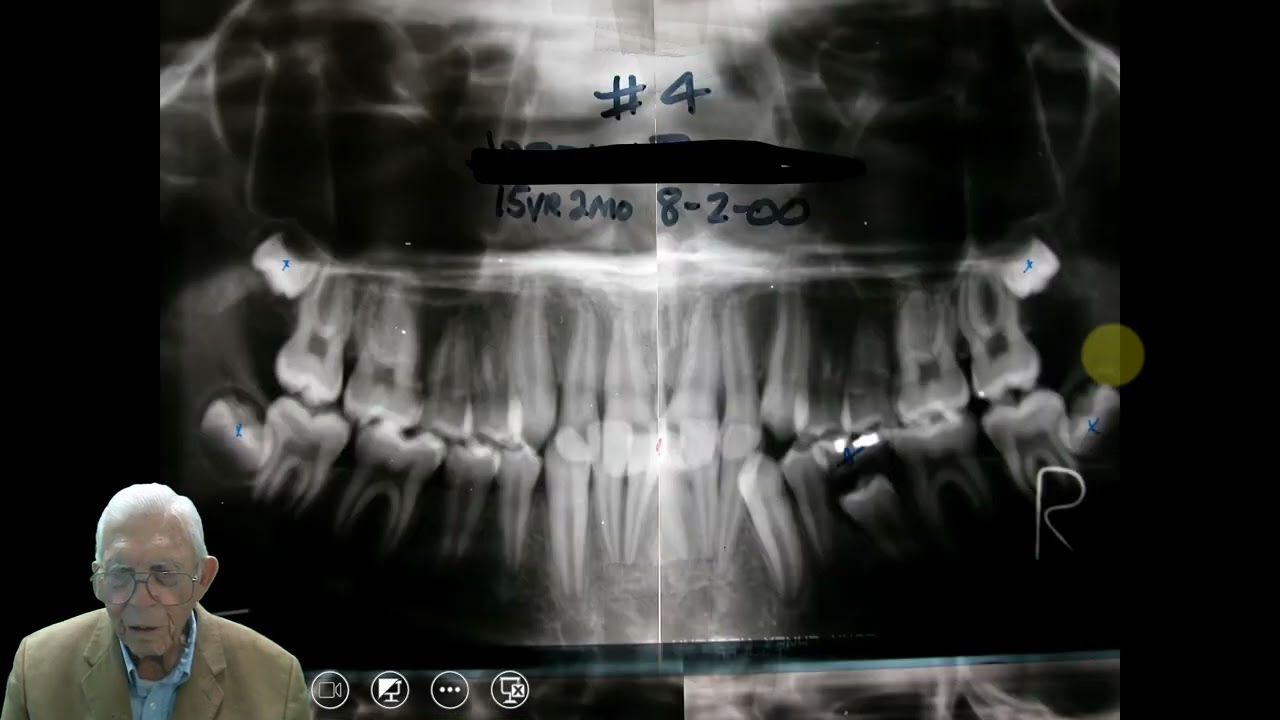 Supernumerary Teeth - Case 2