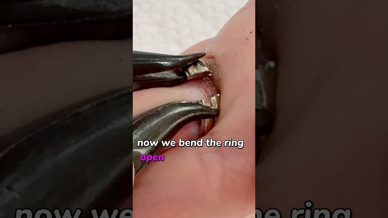 Ring Became STUCK After 52 Years on Her Finger #ring #jewelry #surgeon