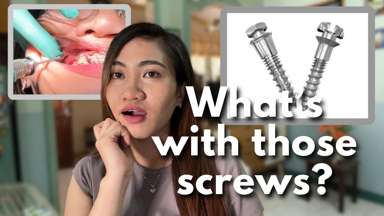 TADs: The small screw that could speed up your treatment!