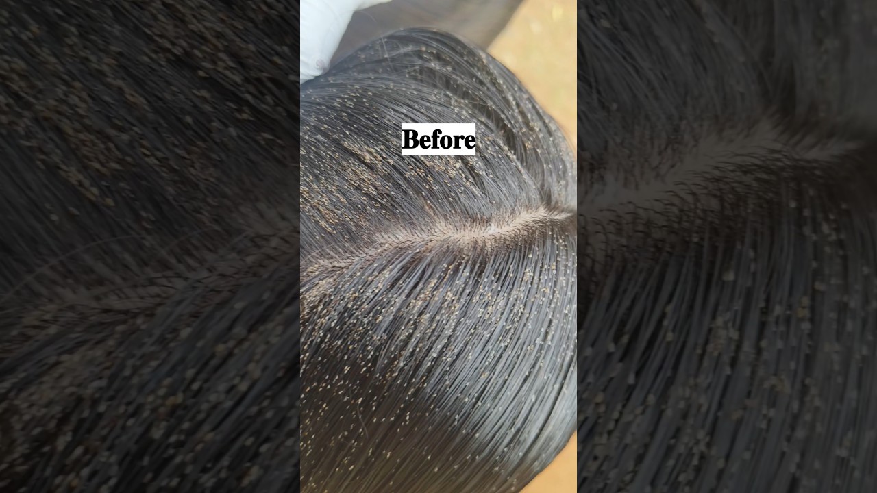 𝐇𝐚𝐢𝐫 𝐋𝐢𝐜𝐞 𝐍𝐢𝐭𝐬 𝐓𝐫𝐞𝐚𝐭𝐦𝐞𝐧𝐭 𝐁𝐞𝐟𝐨𝐫𝐞Vs𝐀𝐟𝐭𝐞𝐫😲🫣#headlicetreatment #headlice #hairstyle #liceremoval #shorts
