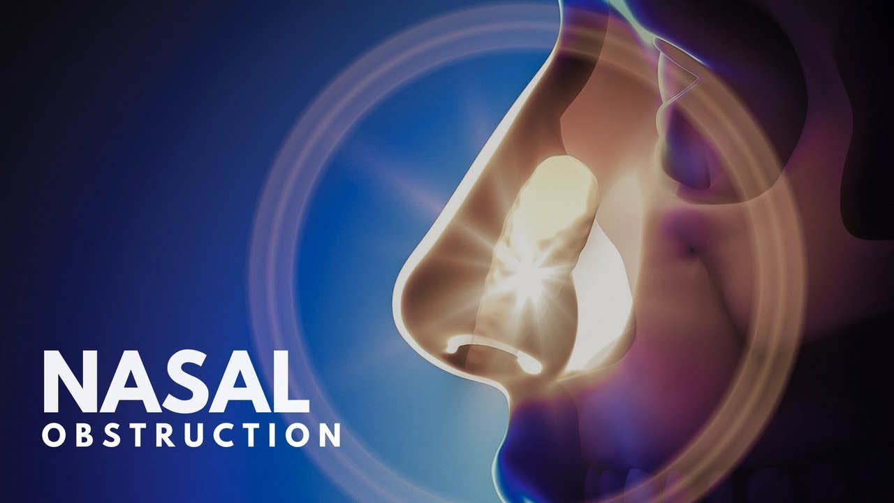 What causes Nasal Obstruction?