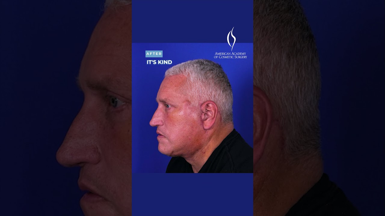 Trilobe Technique in Male Facelifts #facelift #medicaleducation #cosmeticsurgery