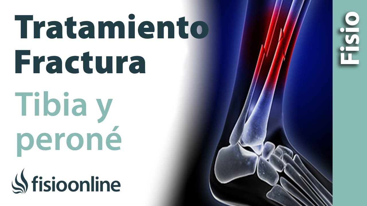 FRACTURA de TIBIA y PERONÉ: Tratamiento desde la fase de INMOVILIZACIÓN