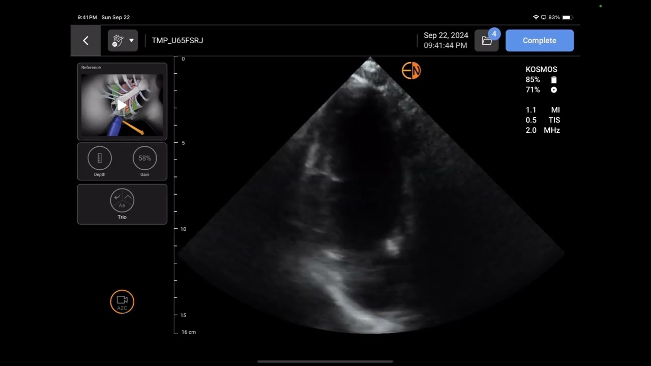 Handheld Ultrasound Review: KOSMOS by Echonous