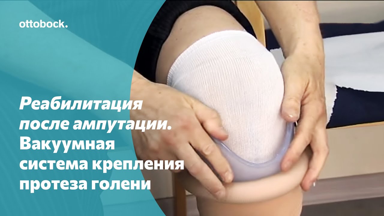 Реабилитация после ампутации. Вакуумная система крепления протеза голени
