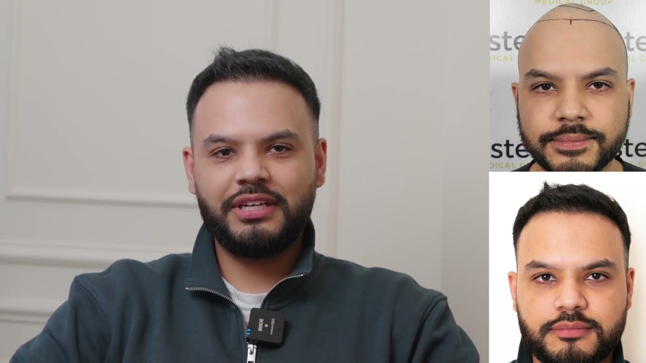 5 Month Hair Transformation with Este Medical | Hair Transplant Before & After