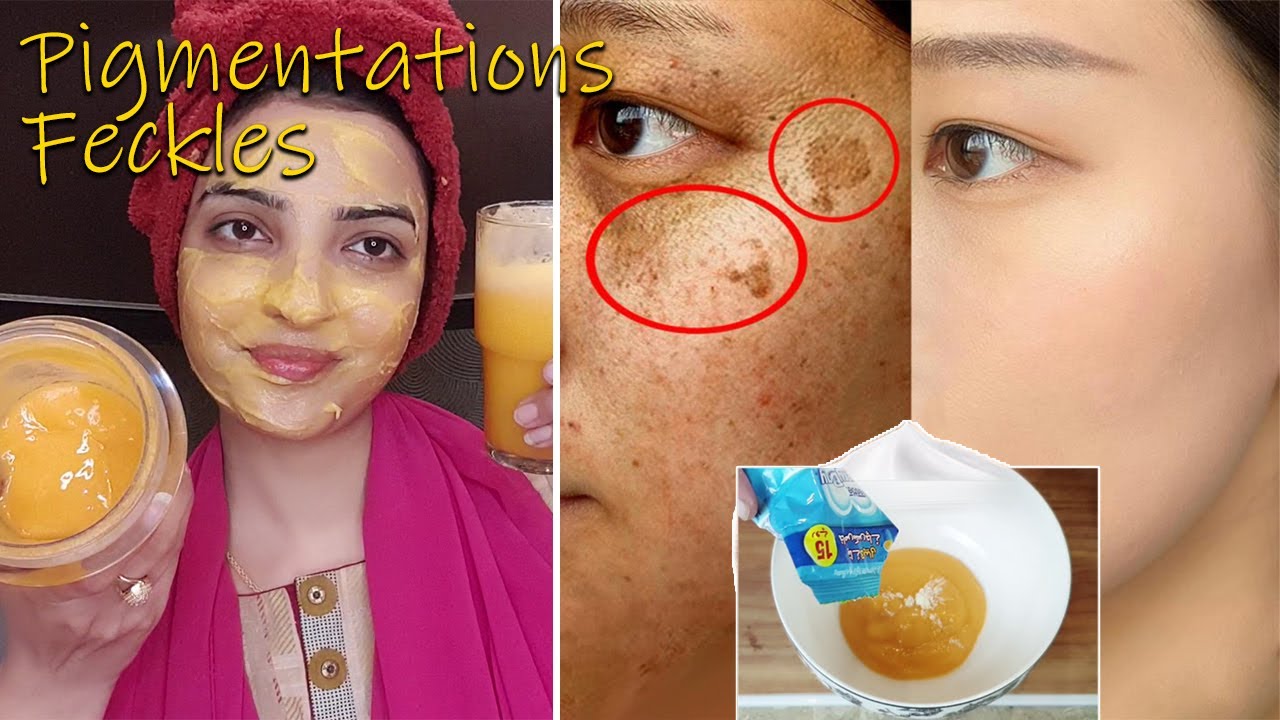 Remove BROWN SPOTS, FRECKLES, & PIMENTATION Permanently A Powerful Remedy for Melasma & Hyper