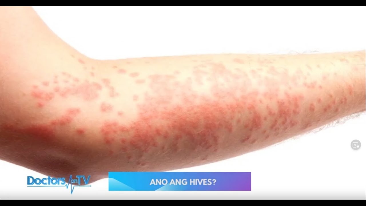 HIVES: Symptoms and Treatment