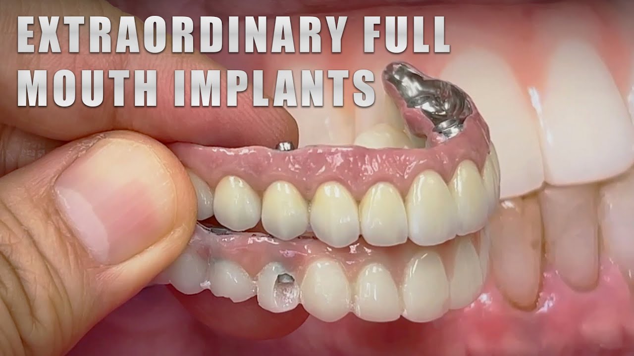 Extraordinary Full Mouth Implants