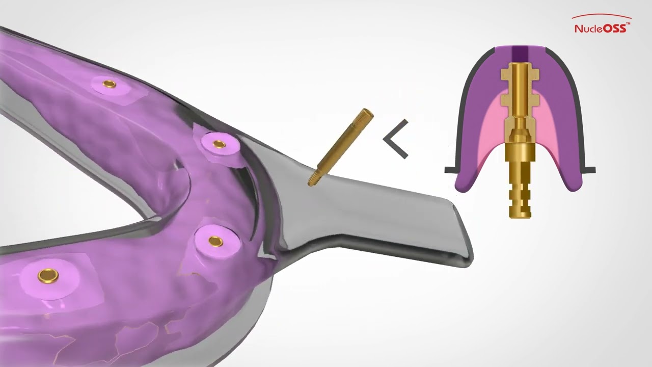 NucleOSS | Screw - retained solutions - prosthesis making with open spoon impression posts