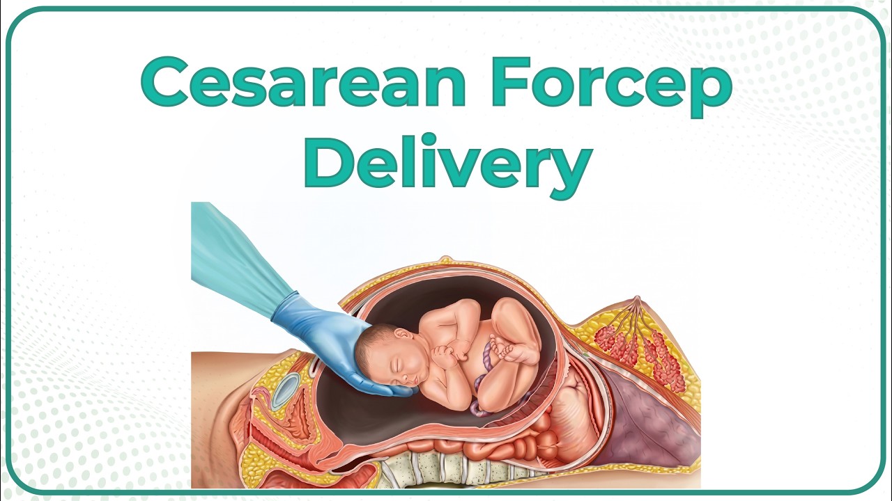 Mastering Caesarean Forceps Delivery: A Step-by-Step 3D Animation Guide
