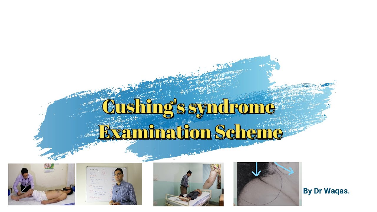 Cushing's Syndrome. (Patient Examination)