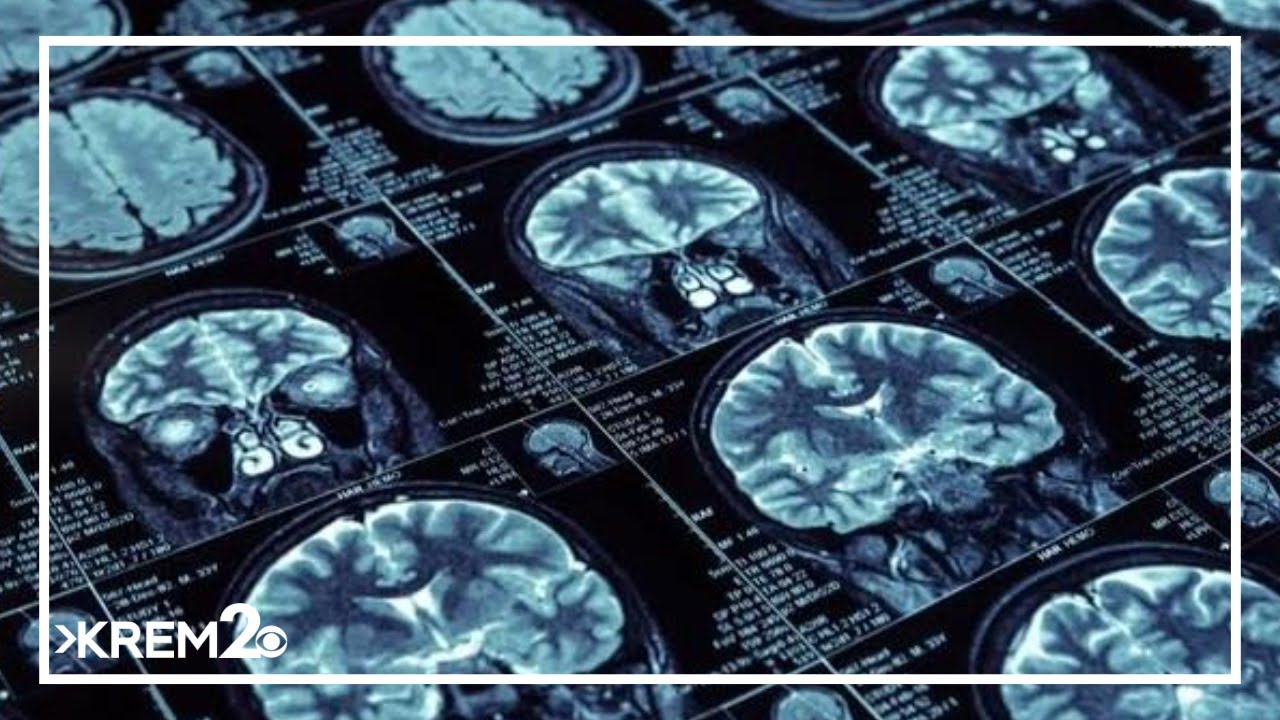 Research aims to find treatment for neuro-degenerative brain diseases