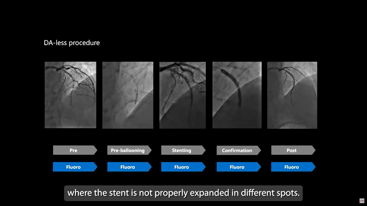 DA-less Procedure with αEvolve Imaging experience – Dr. Sanjeevan Pasupati
