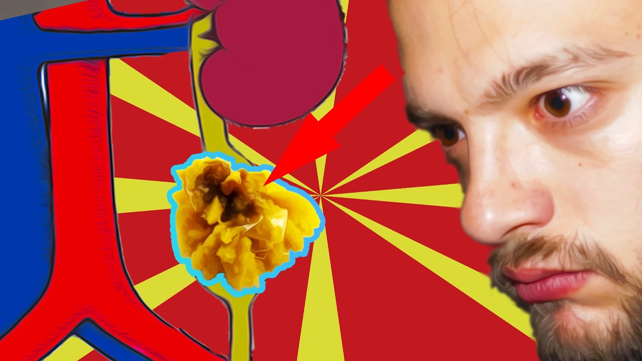 Coliche Renali? Forse è un CALCOLO... adesso - Spiegazione