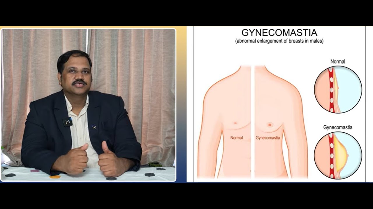 Gynecomastia Treatment for Men |  పురుషులకు గైనకోమాస్టియా చికిత్స | Dr Ramprabhu - 99498 08628