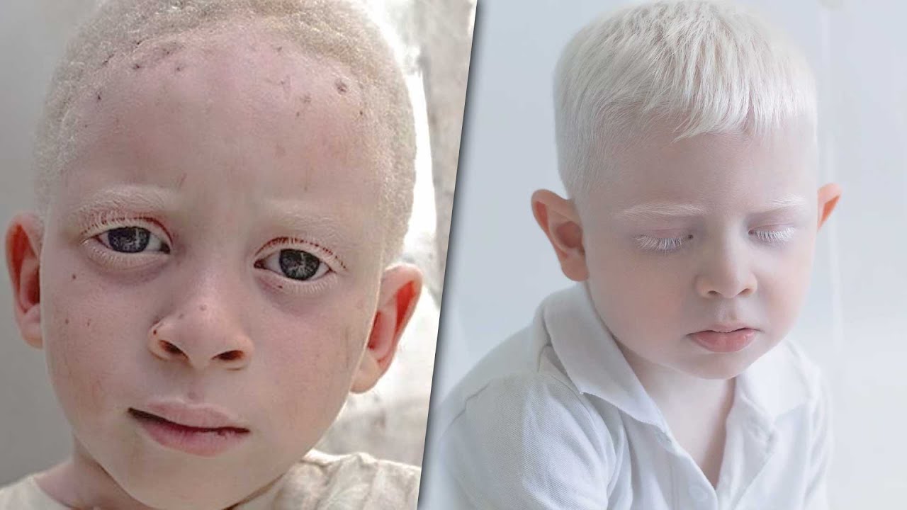 Datos sorprendentes de los Albinos que no sabías