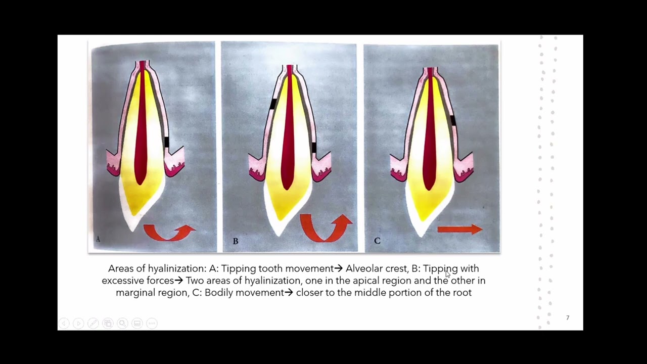 Hyalinization in Tooth Movement | Orthodontics | Dentophile