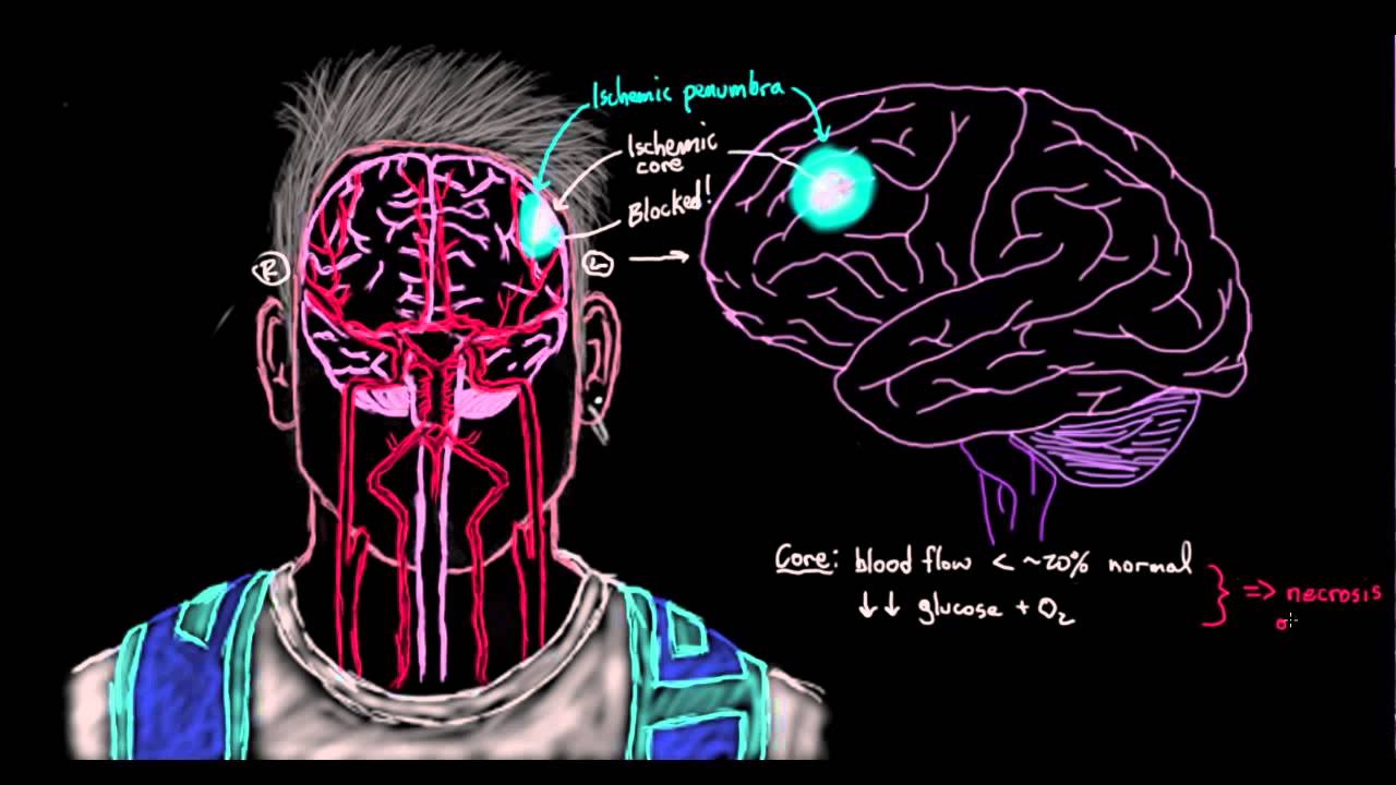 Khan Academy - Ischemic Core and Penumbra