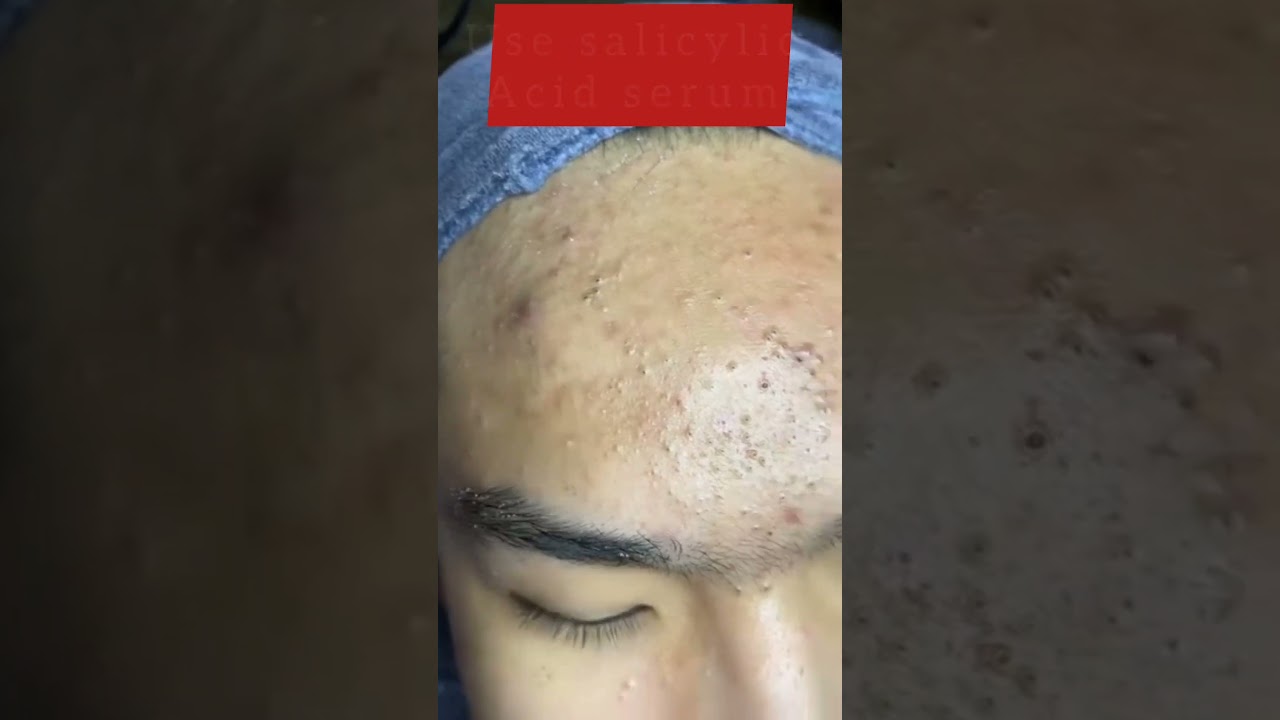 dermaco salicylic acid serum review #blackheads