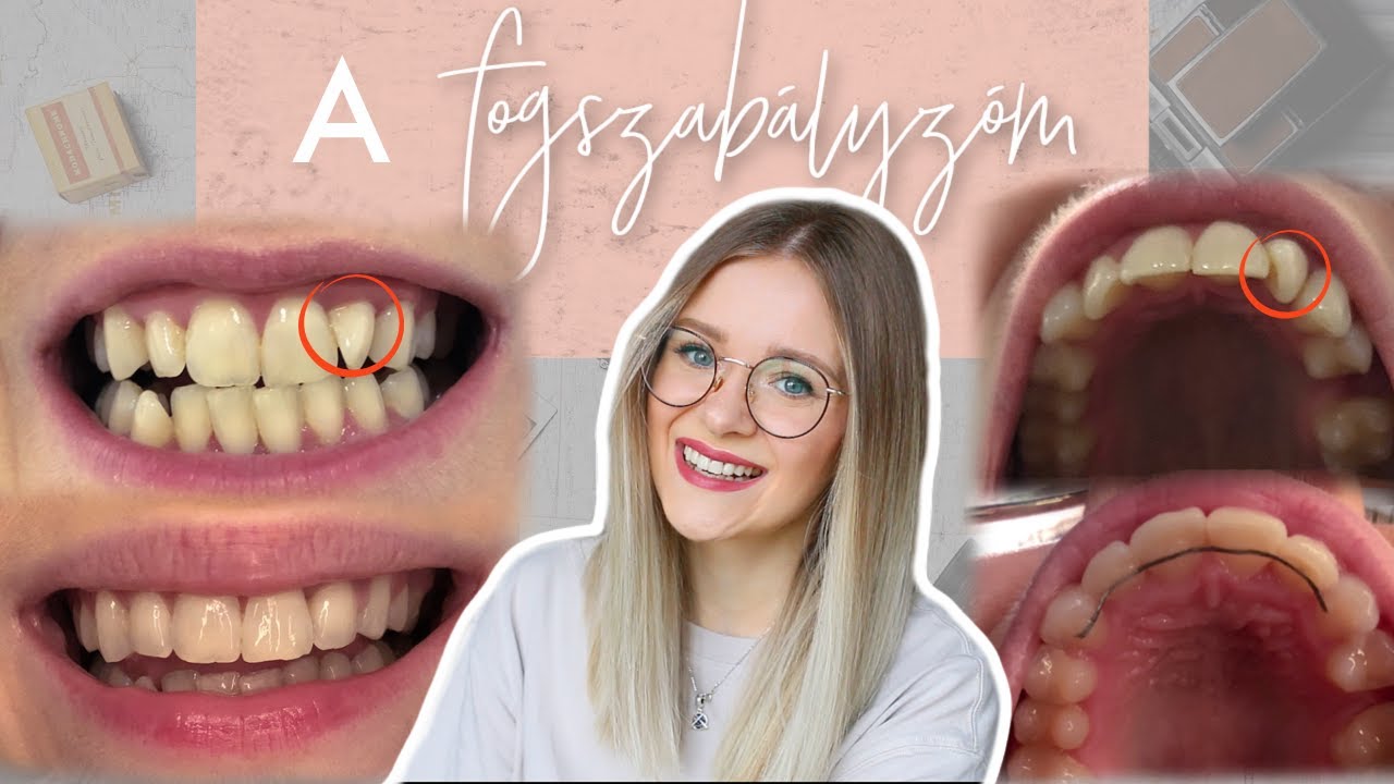 Mindent a fogszabályzóról | Mennyibe került? fáj? mit nem szabad enni?
