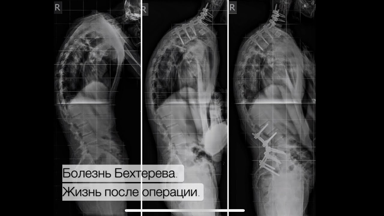 Болезнь Бехтерева