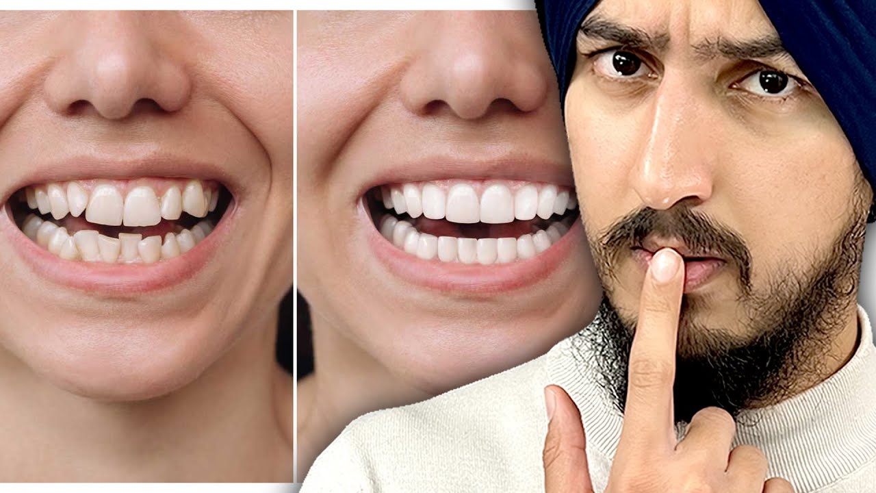 The Secret to a Perfect Hollywood Smile (It’s Not Just Veneers)
