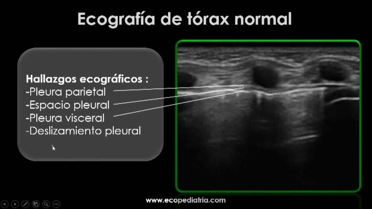 Ecografía de Derrame Pleural