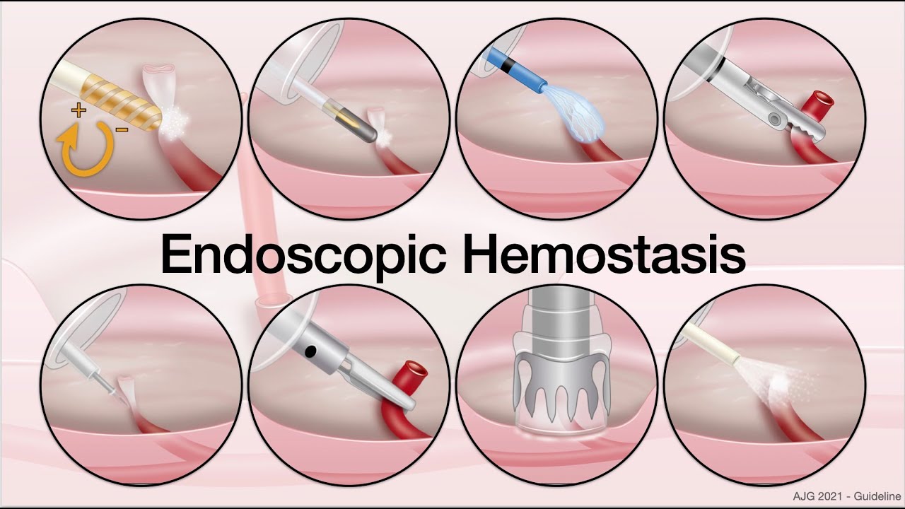 GI Lecture Series - UGI Bleeding - Peptic Ulcer Bleeding Endoscopic Therapy