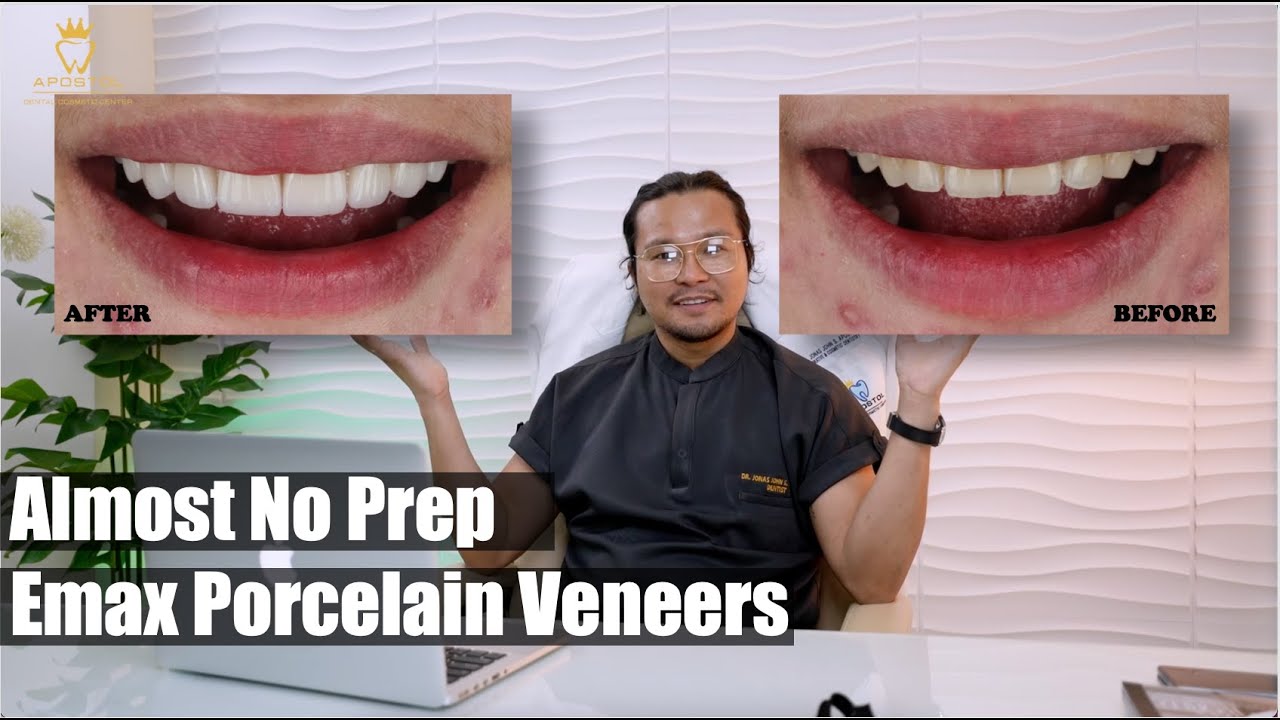 New Year New Smile with Emax Porcelain Veneers