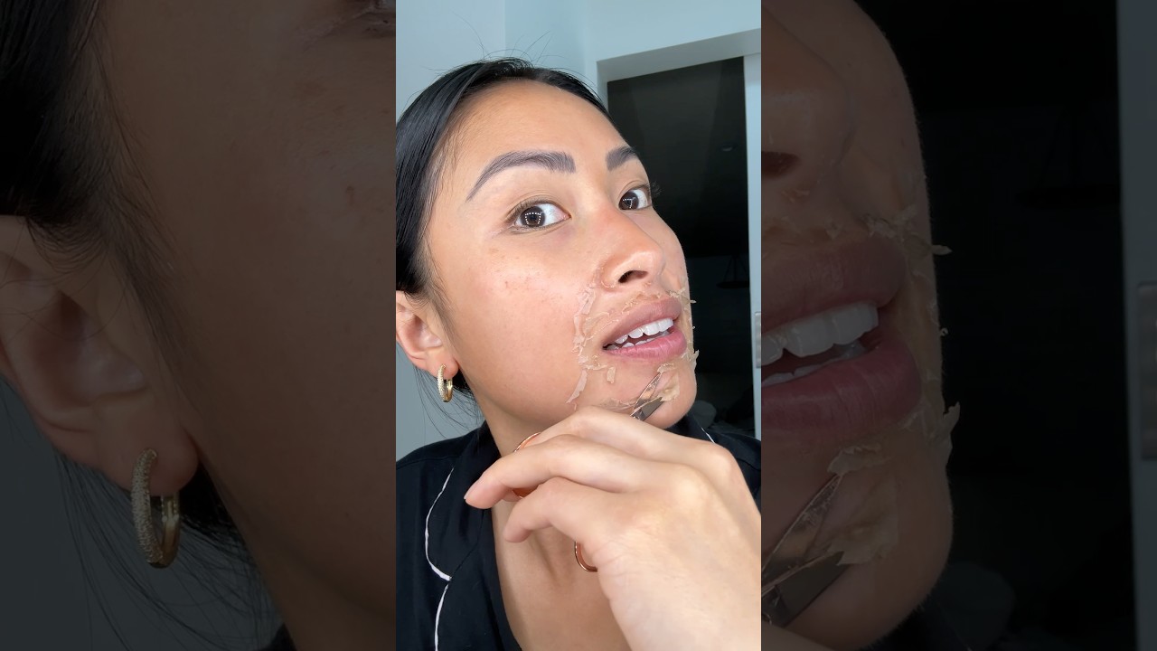 Day 4 chemical peel back by popular request with no audio #skin #chemicalpeel #skincare #acnescars