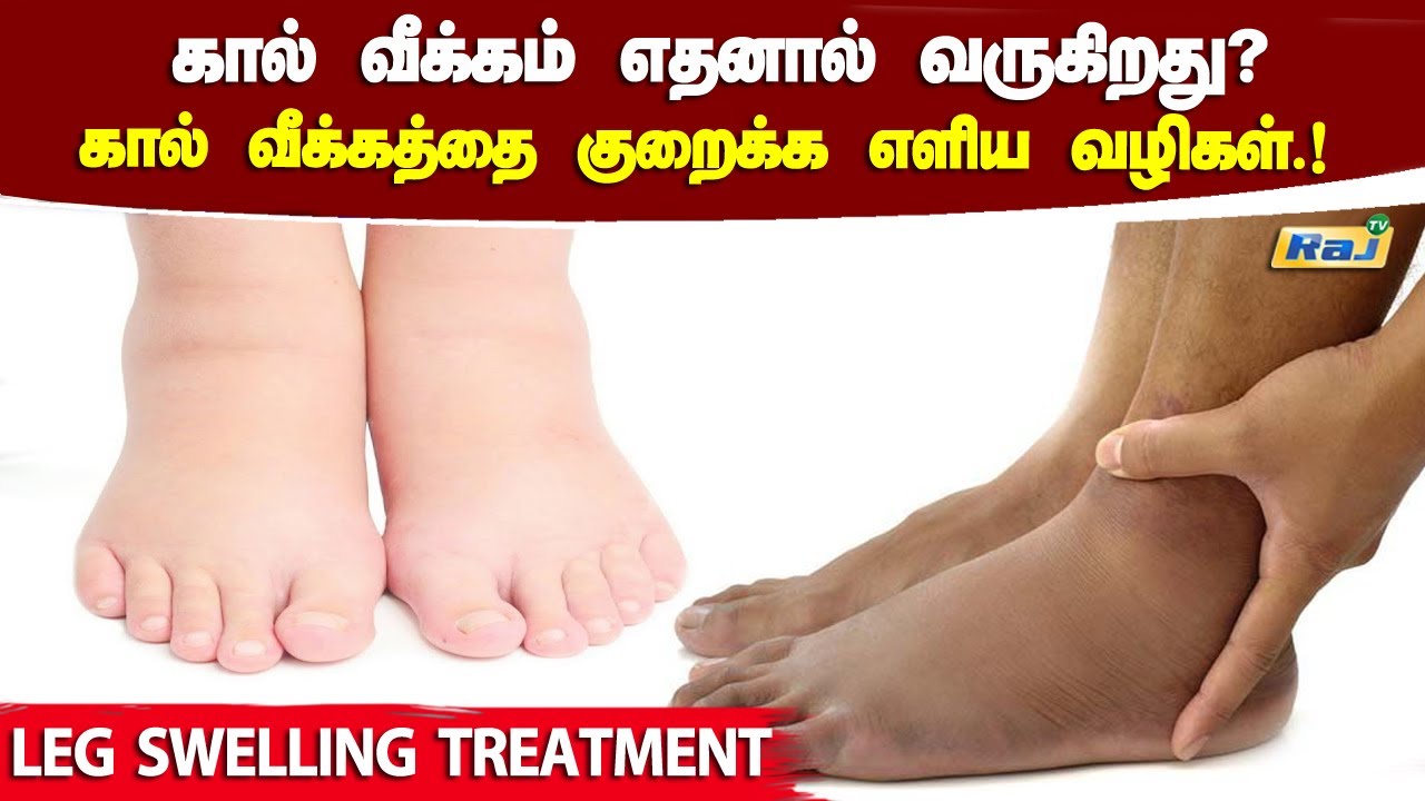 கால் வீக்கம் எதனால் வருகிறது? கால் வீக்கம் குறைய என்ன செய்யணும்? | Leg Swelling Reasons & Treatment