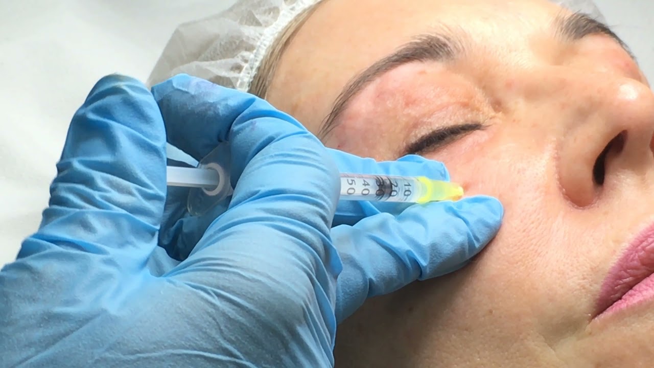 Vídeo de Tratameinto de Zona Periocular con Sunekos® 200