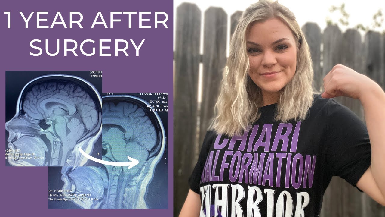 1 Year After Brain Surgery | Chiari Malformation Decompression