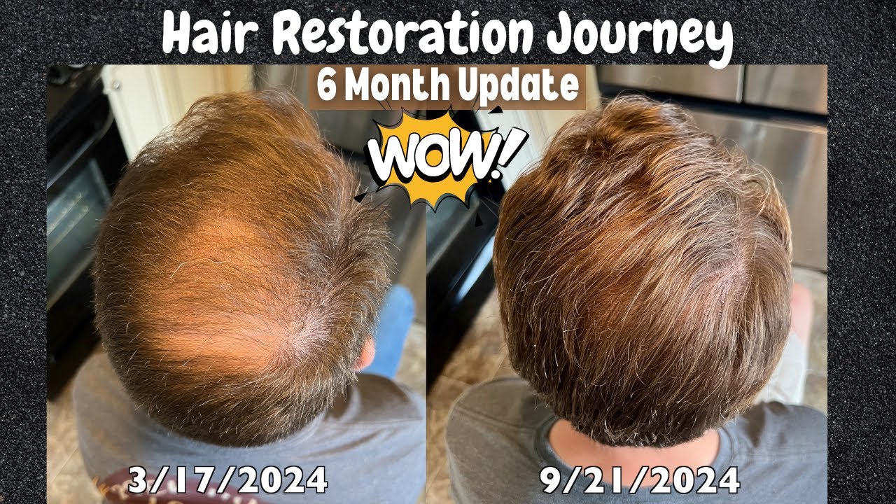 Hair Restoration Journey - 6 Month Update (Big Results!)