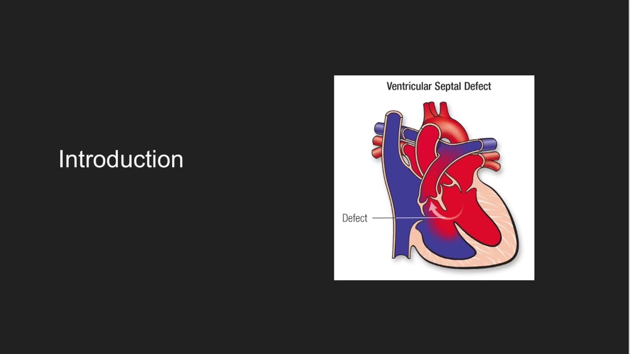 Ventricular Septal Defects (Natural History and Clinical Presentation)