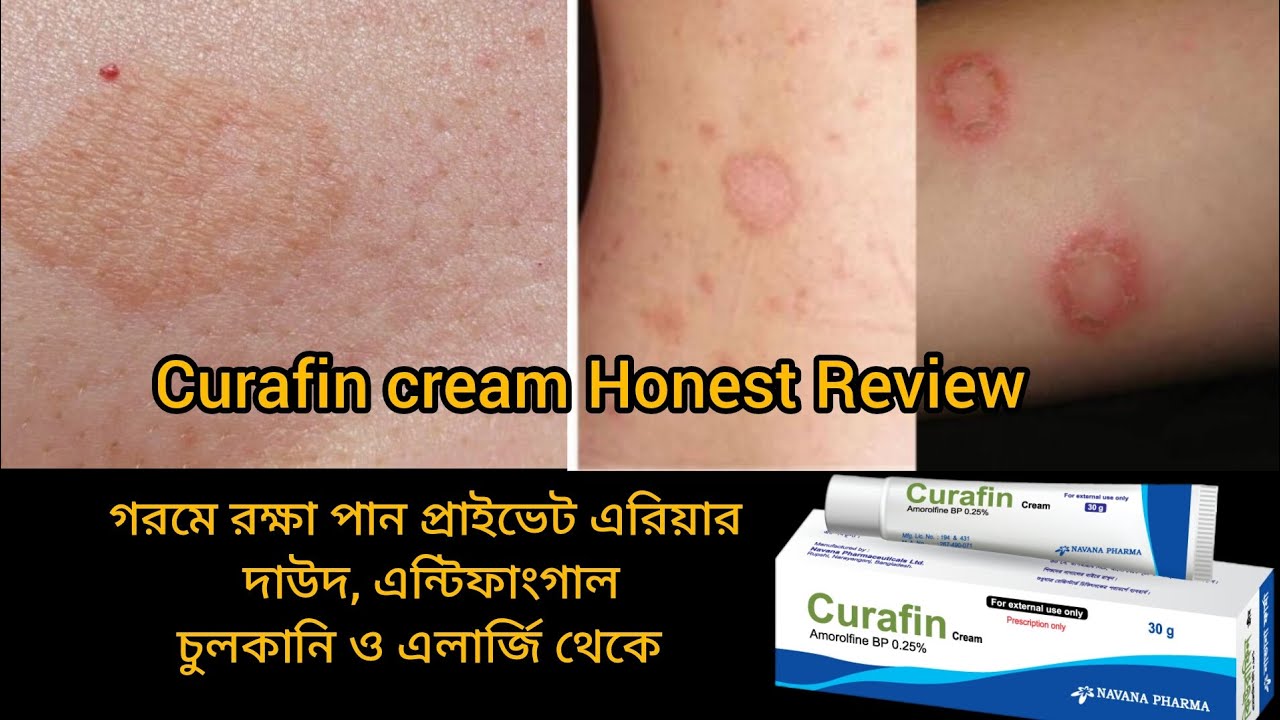 Curafin Cream Honest Review|কিউরাফিন ক্রিমের কাজ কি?|প্রাইভেট এরিয়ার ছত্রাকজনিত রোগ|Bangla|Shajbo|