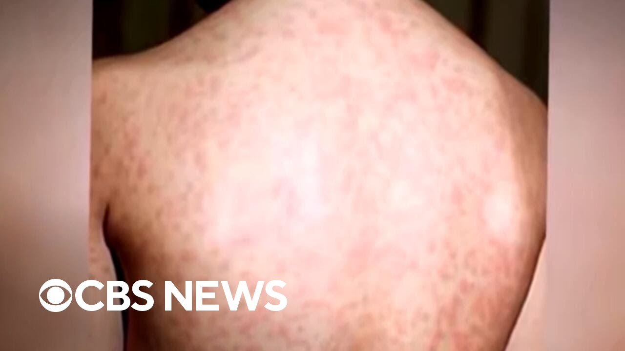 Texas measles outbreak grows