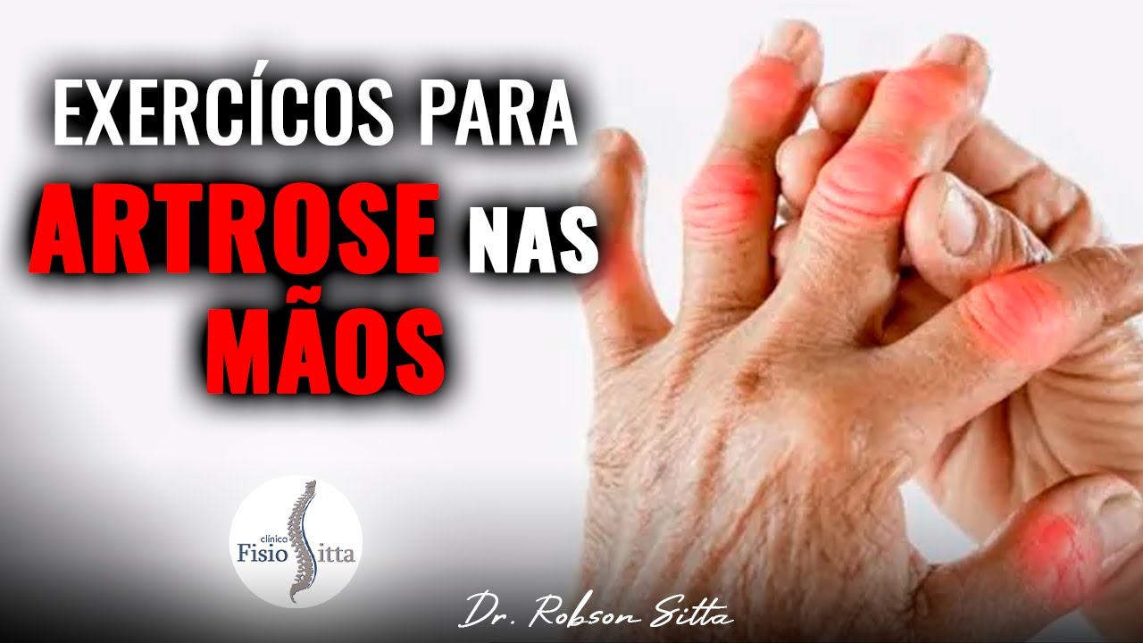 EXERCÍCIOS PARA ARTROSE NOS DEDOS DAS MÃOS FISIOTERAPIA MANUAL Clínica Dr. Robson Sitta ®
